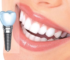 ایمپلنت و پیوند استخوان