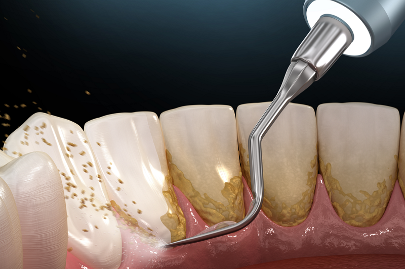 مراقبت های بعد از جرم گیری دندان + عوارض احتمالی بعد از آن - کلینیک دندانپزشکی ماهان