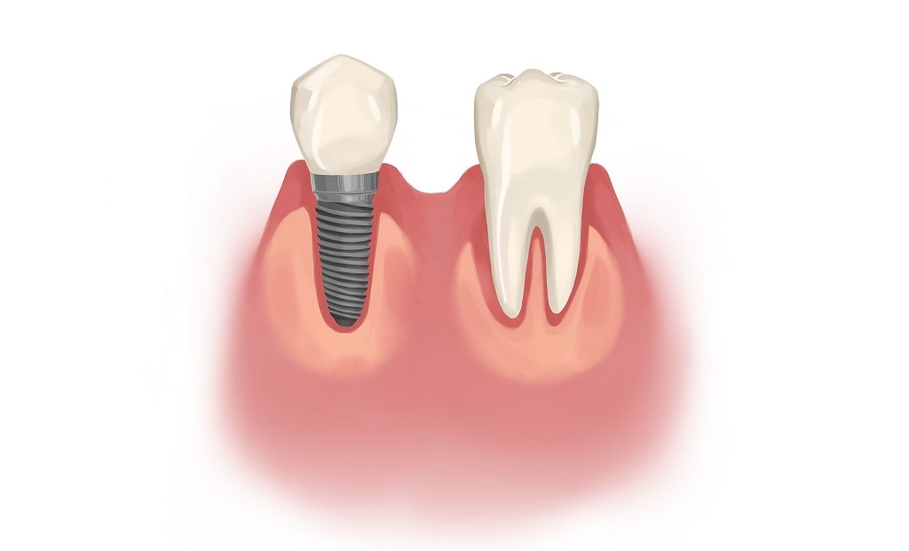 آیا ایمپلنت دندان دائمی است؟ ماندگاری ایمپلنت دندان
