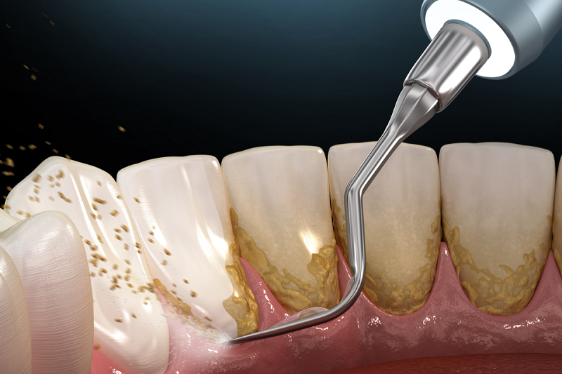 مراقبت های بعد از جرم گیری + عوارض احتمالی بعد از آن