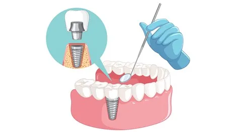 مراقبت های بعد از ایمپلنت دندان