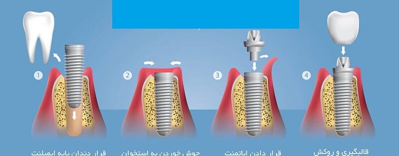 مراحل عمل جراحی کاشت ایمپلنت دندان