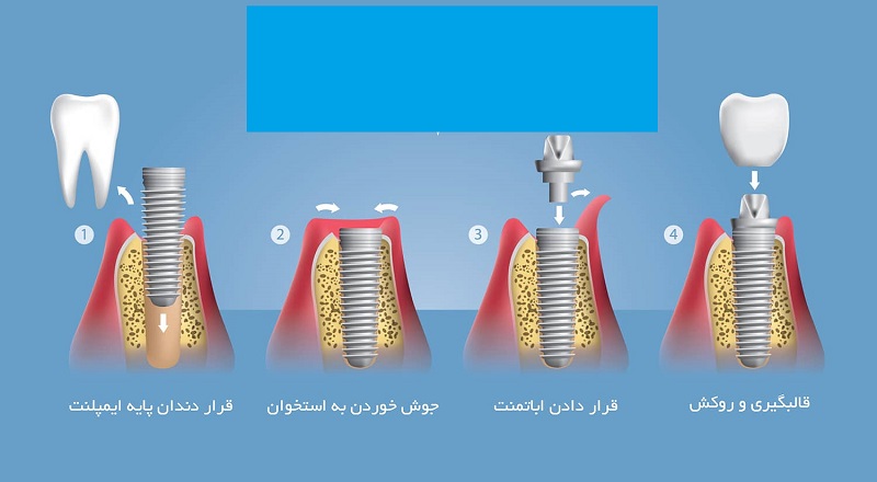 مراحل عمل جراحی کاشت ایمپلنت دندان