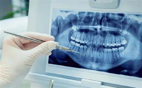 آنتی بیوتیک طبیعی برای عفونت دندان