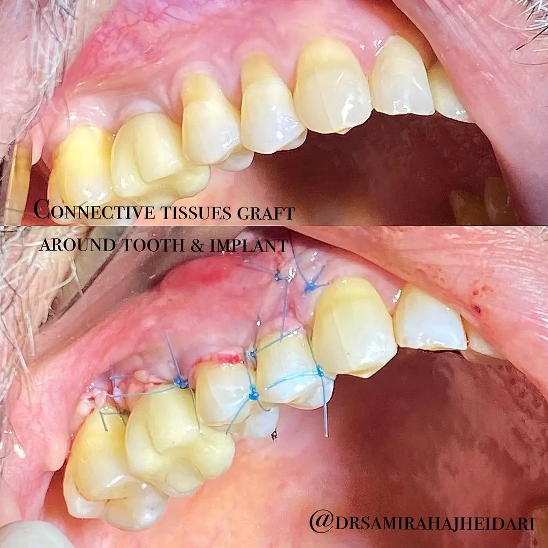 پیوند لثه در اطراف ایمپلنت و دندان فک بالا