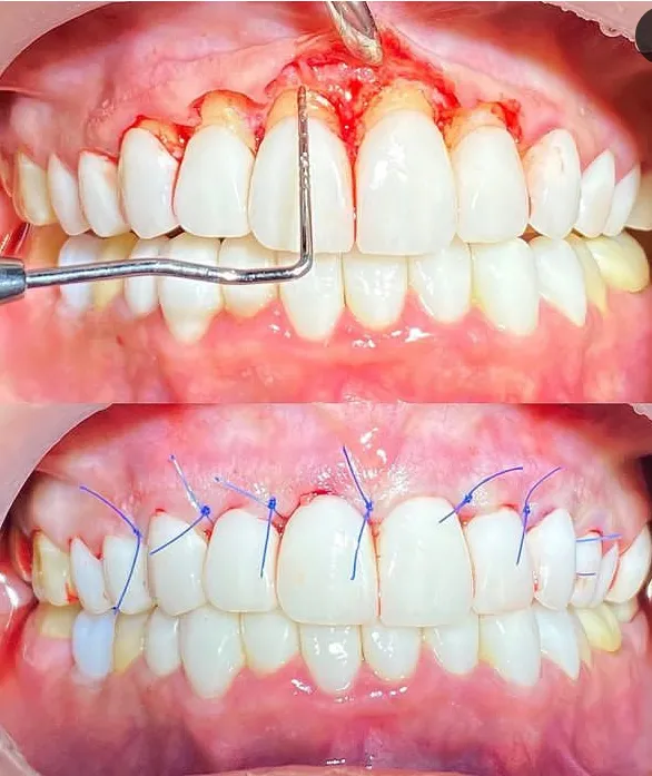 زمان بهبود در لیفت لثه با لیزر بهتر است یا با جراحی؟