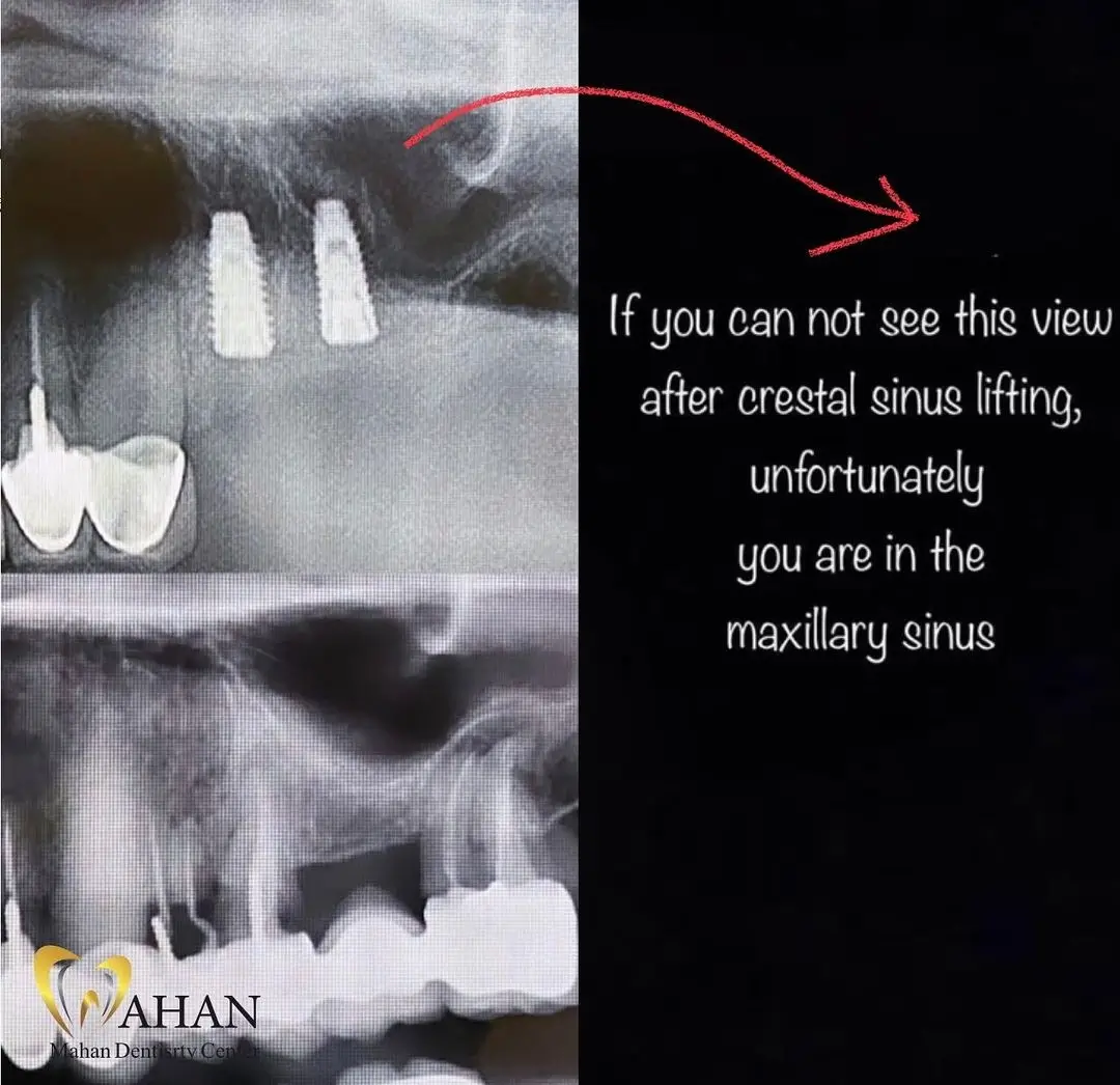 کاشت دو واحد ایمپلنت در فک بالا به همراه لیفت سینوس بسته