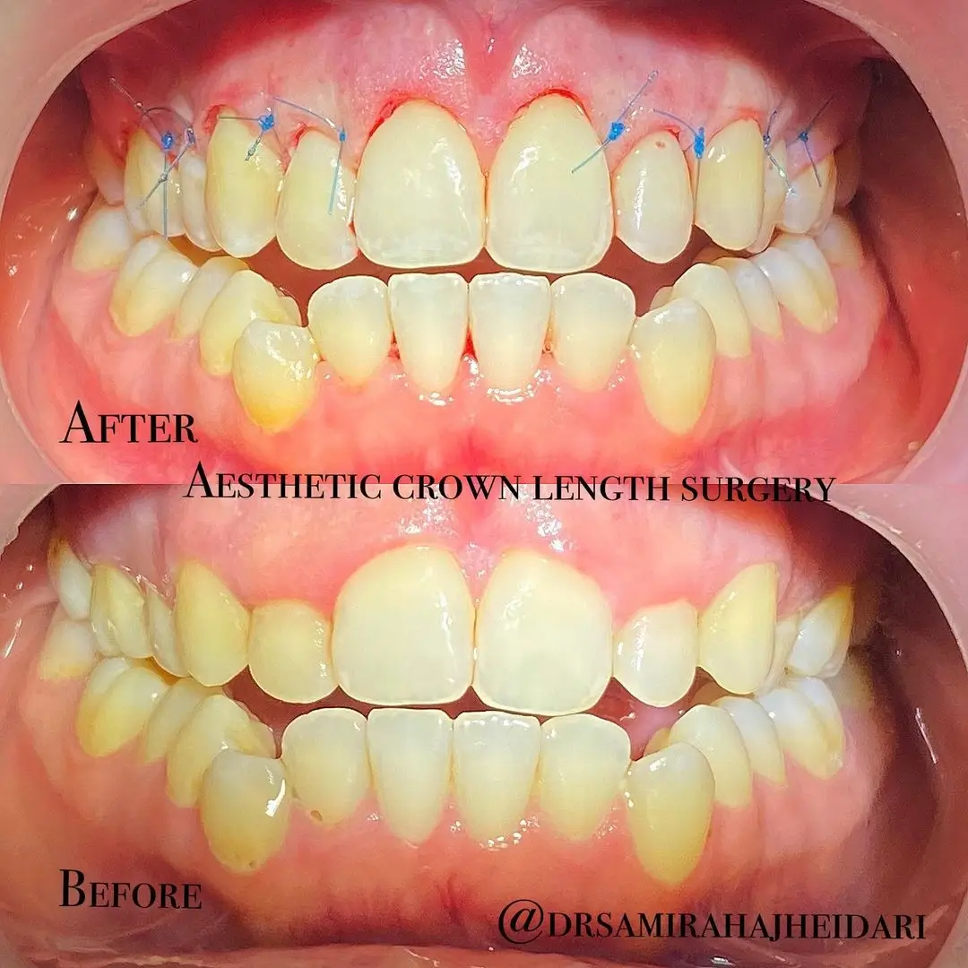 جراحی زیبایی طول تاج در فک قدامی فک بالا