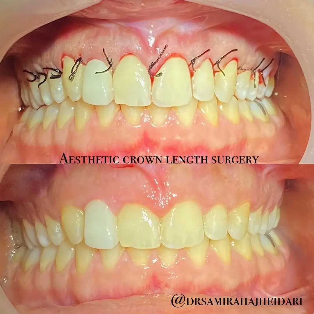 aesthetic crown length surgery in anterior maxillary jaw