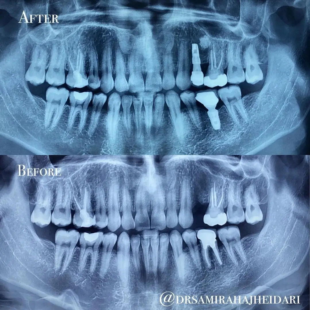 کاشت یک واحد ایمپلنت در فک بالا و پایین در بیمار با تخریب شذیذ استخوان خصوصا در فک بالا