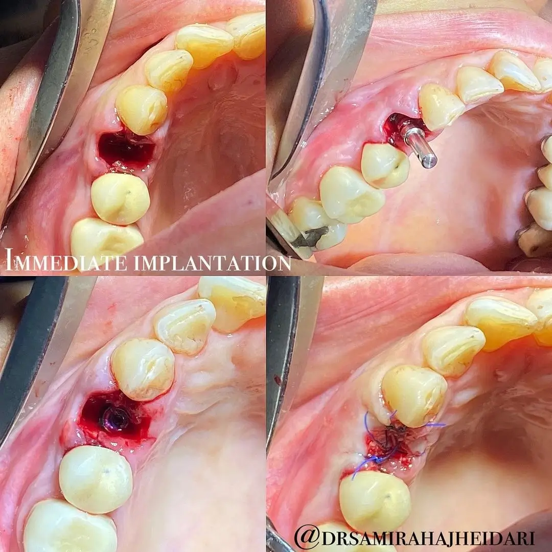 fresh socket implantation