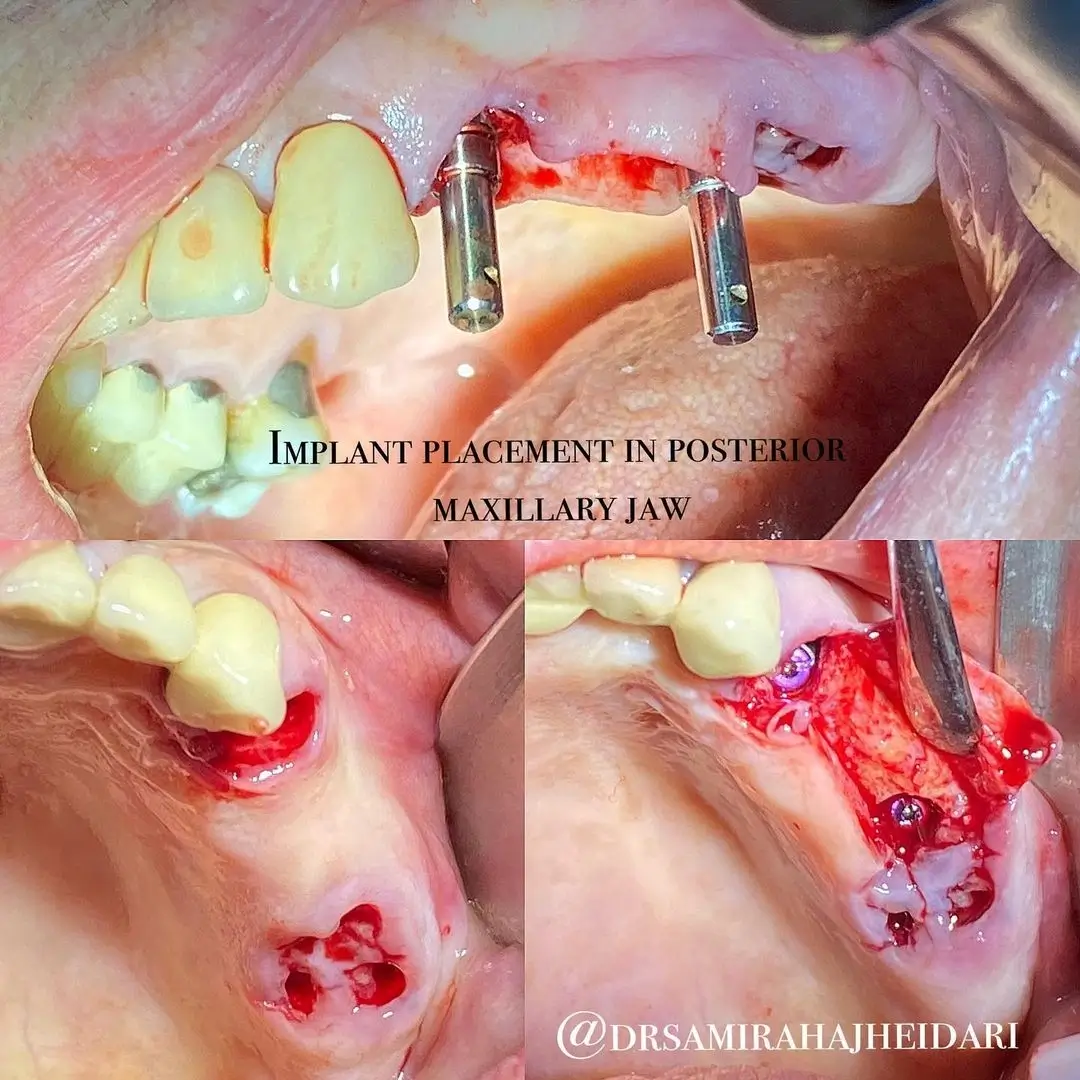خونریزی دندان بعد از ایمپلنت