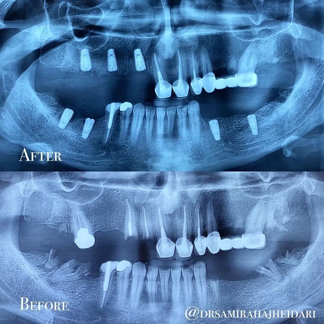 کاشت 8 واحد ایمپلنت در فک بالا و پایین 