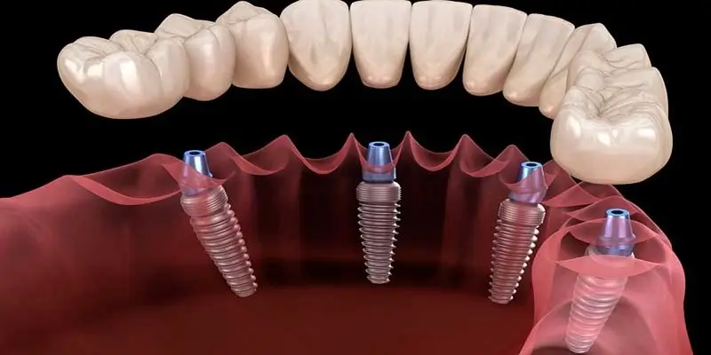 آیا می‌شود تمام دندان‌ها را ایمپلنت کرد؟