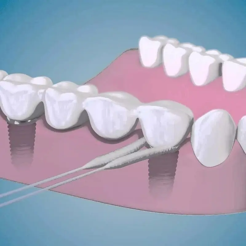 نحوه استفاده از نخ دندان ایمپلنت