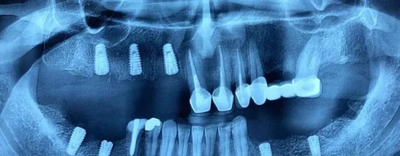 ایمپلنت کره ای بهتر است یا آلمانی