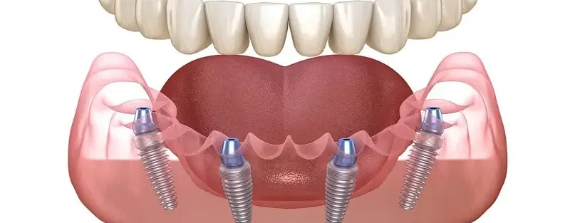 کاشت دندان به روش All-on-4