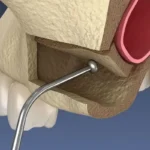 در چه مواقعی جراحی سینوس لیفت لازم است؟