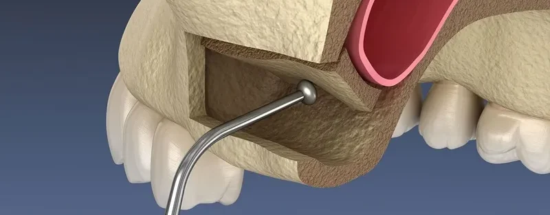 جراحی سینوس لیفت