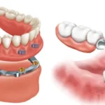 تفاوت ایمپلنت دندان و پروتز دندان چیست؟