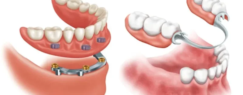 ایمپلنت دندان و پروتز دندان