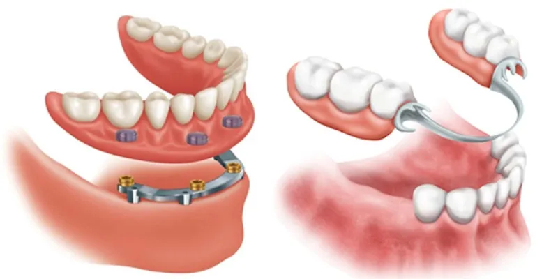 ایمپلنت دندان و پروتز دندان