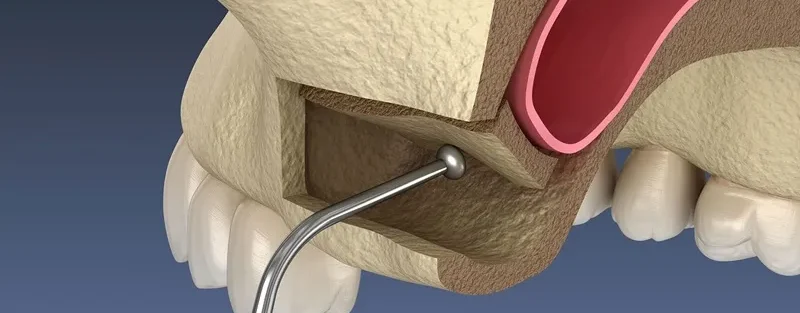 جراحی لیفت سینوس