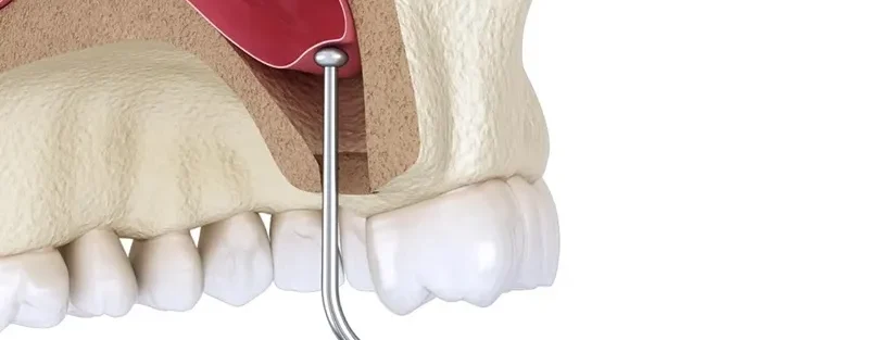 لیفت سینوس باز و بسته