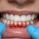 جراحی فلپ لثه چیست؟ مراحل، مزایا و مراقبت‌های بعد از عمل