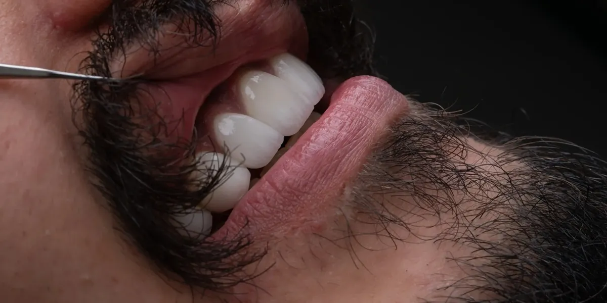 کامپوزیت دندان اقساطی در تهران