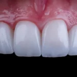 بهترین متخصص روکش دندان در تهران و کرج