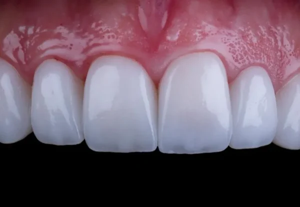 متخصص روکش دندان در تهران و کرج