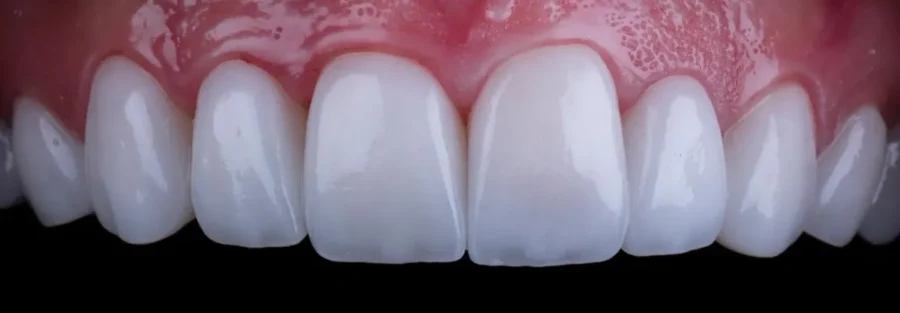 متخصص روکش دندان در تهران و کرج