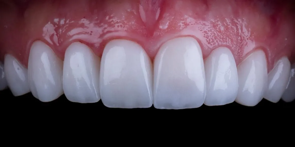 متخصص روکش دندان در تهران و کرج