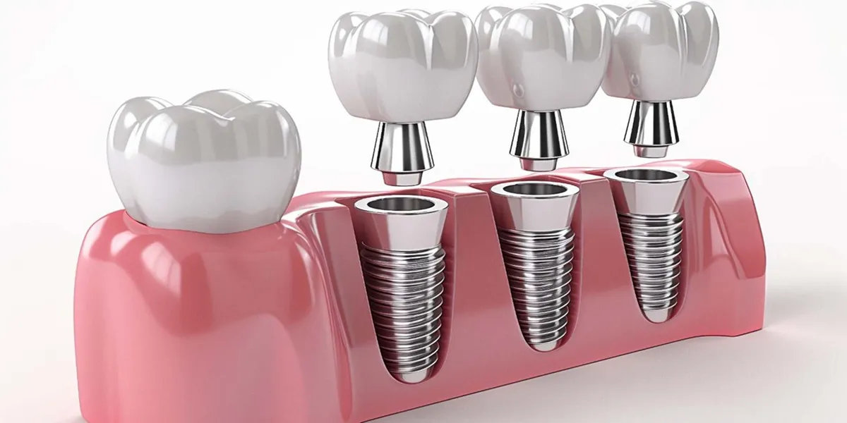 اگر ایمپلنت نکنیم چه میشود؟