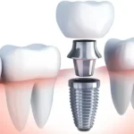 بهترین متخصص ایمپلنت دیجیتال در تهران و کرج