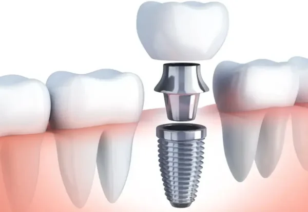 بهترین متخصص ایمپلنت دیجیتال در تهران و کرج