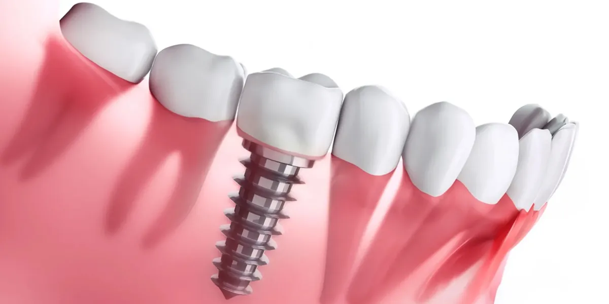 بهترین متخصص ایمپلنت دیجیتال در تهران و کرج