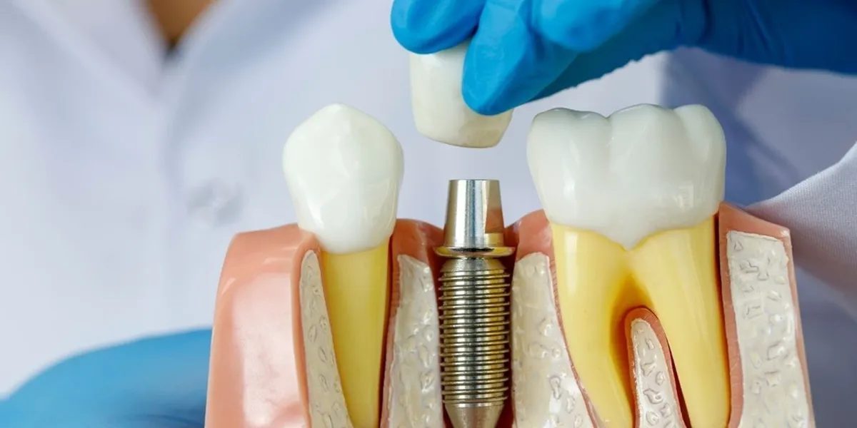 آیا ایمپلنت باعث تحلیل استخوان فک می شود