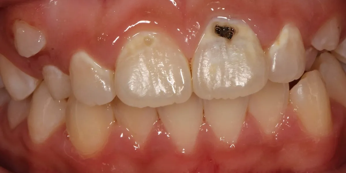 پوسیدگی دندان بعد از کامپوزیت