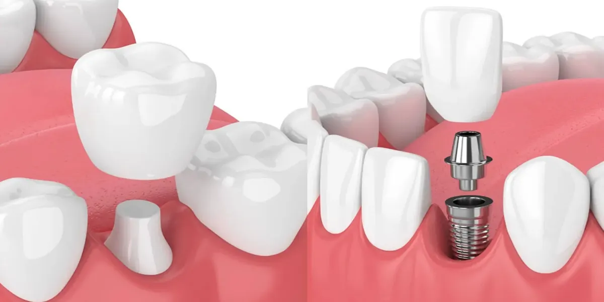 آیا ایمپلنت باعث تحلیل استخوان فک می شود