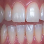 طول عمر کامپوزیت دندان به چه عواملی بستگی دارد؟