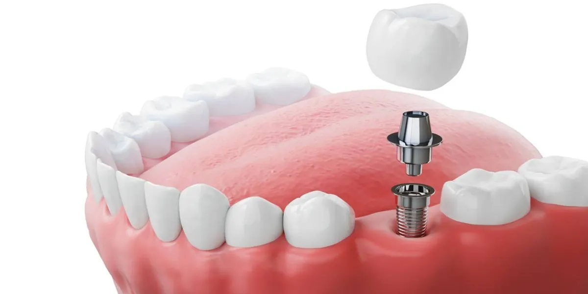 آیا ایمپلنت باعث تحلیل استخوان فک می شود