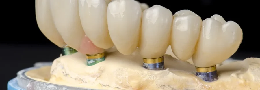 تفاوت ایمپلنت تک دندان با ایمپلنت کامل فک