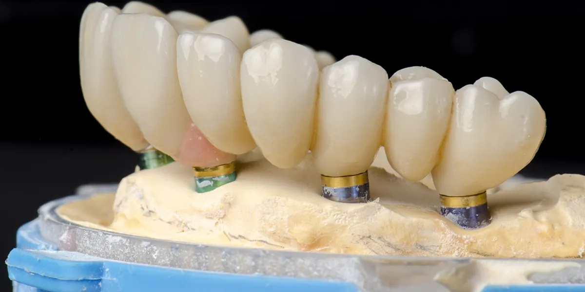 تفاوت ایمپلنت تک دندان با ایمپلنت کامل فک