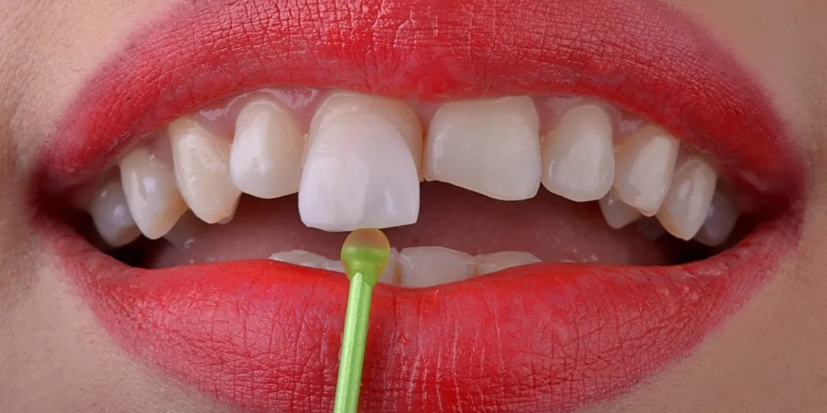 بهترین متخصص لمینت در تهران و کرج