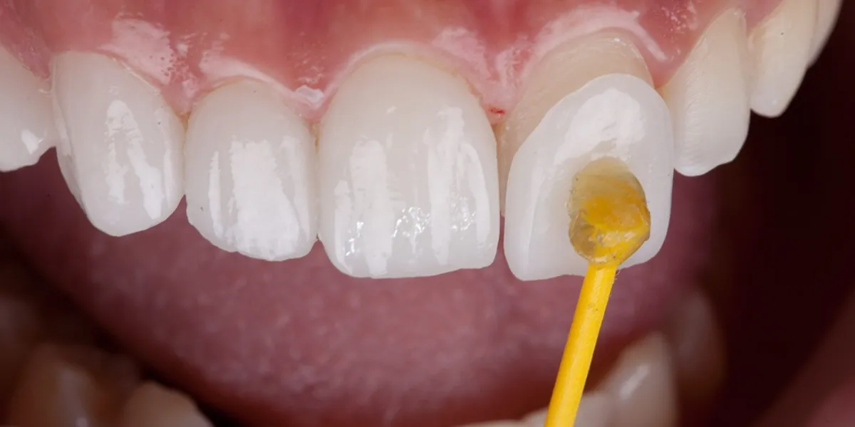 متخصص روکش دندان در تهران و کرج