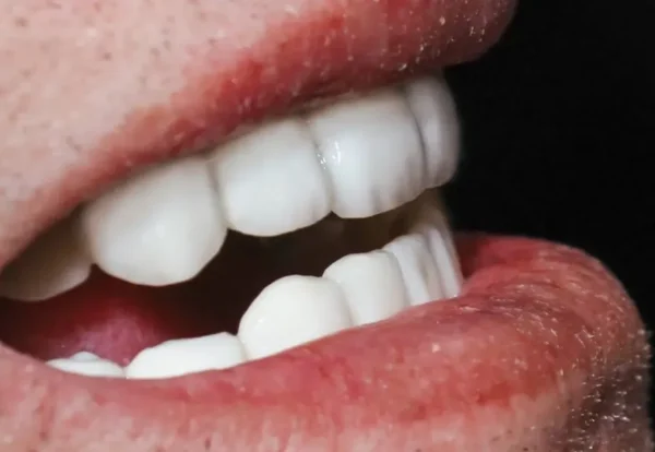 ایمپلنت all on 6 چیست؟