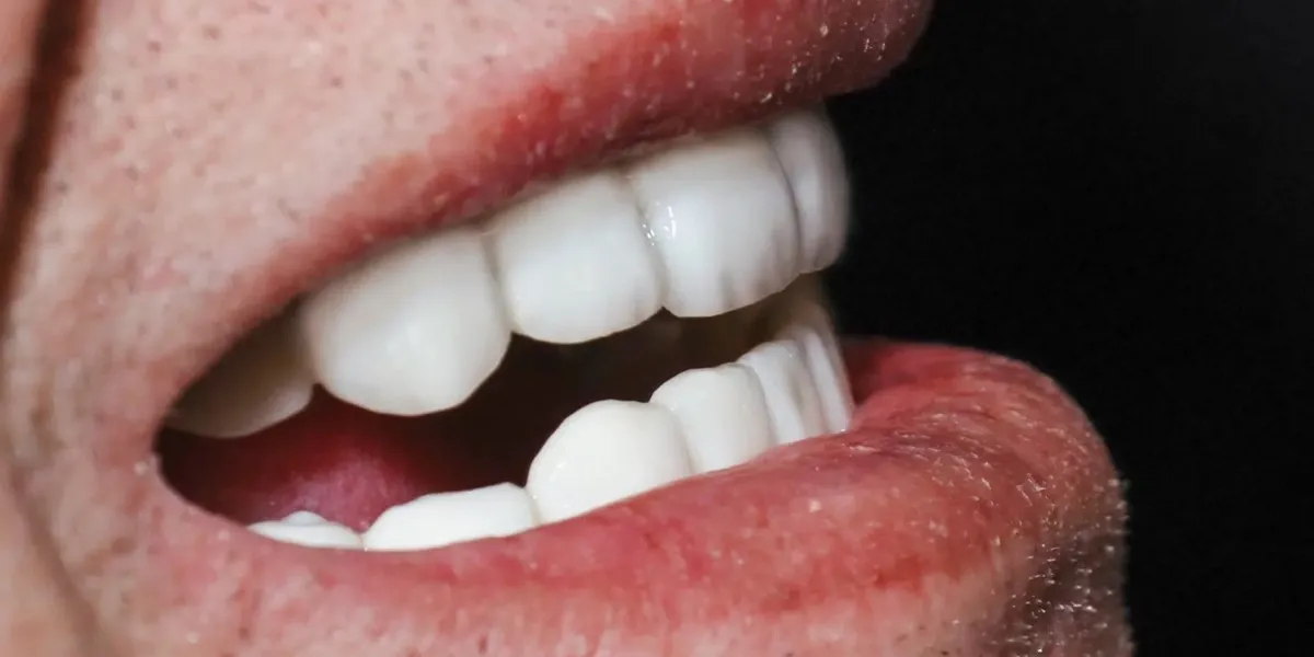 ایمپلنت all on 6 چیست؟