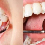 پوسیدگی دندان بعد از کامپوزیت